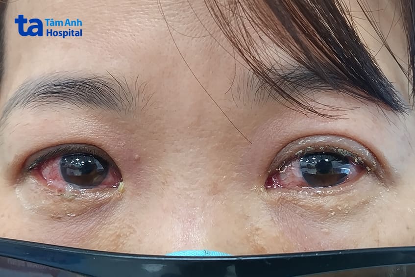 Học sinh nghỉ học, phụ huynh nghỉ làm do đau mắt đỏ