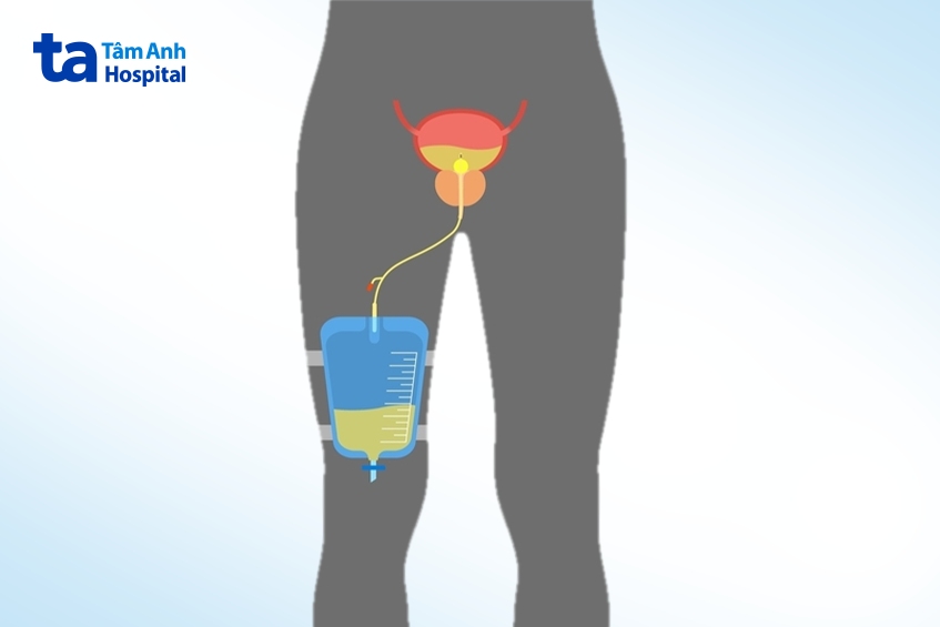 chăm sóc sau khi đặt ống thông tiểu