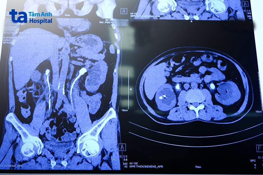 Kết quả chụp CT