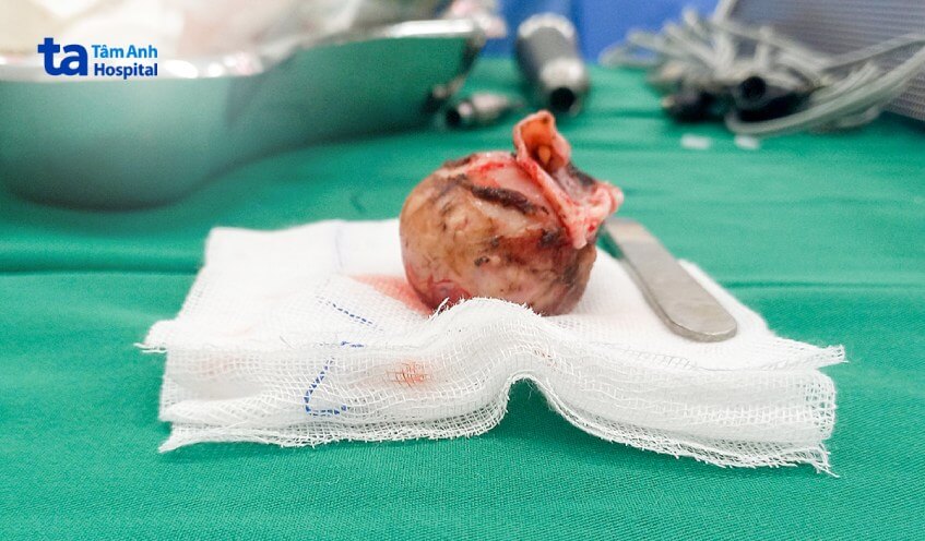 khối u 4cm gây lõm vỏ não