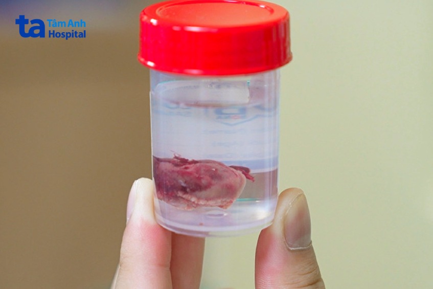 khối u được loại bỏ