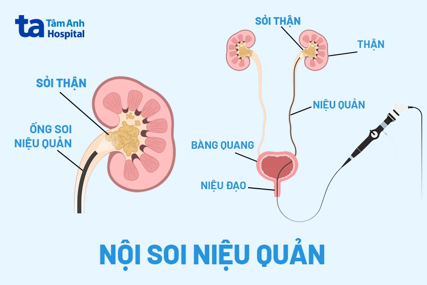 Mô phỏng kỹ thuật tán sỏi nội soi bằng ống mềm.