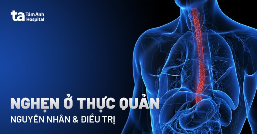 nghẹn ở thực quản