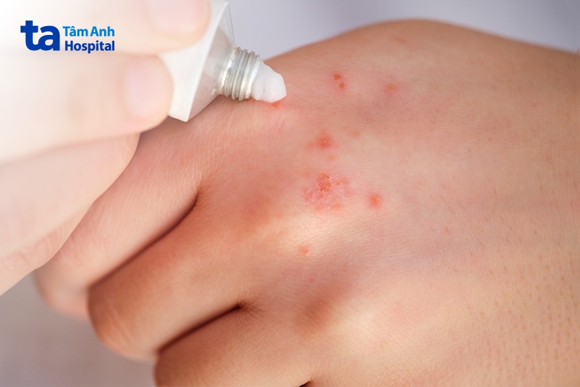 người bệnh chỉ cần dùng một lớp mỏng