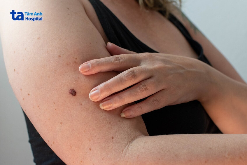 người bị loạn sản nên tầm soát ung thư da