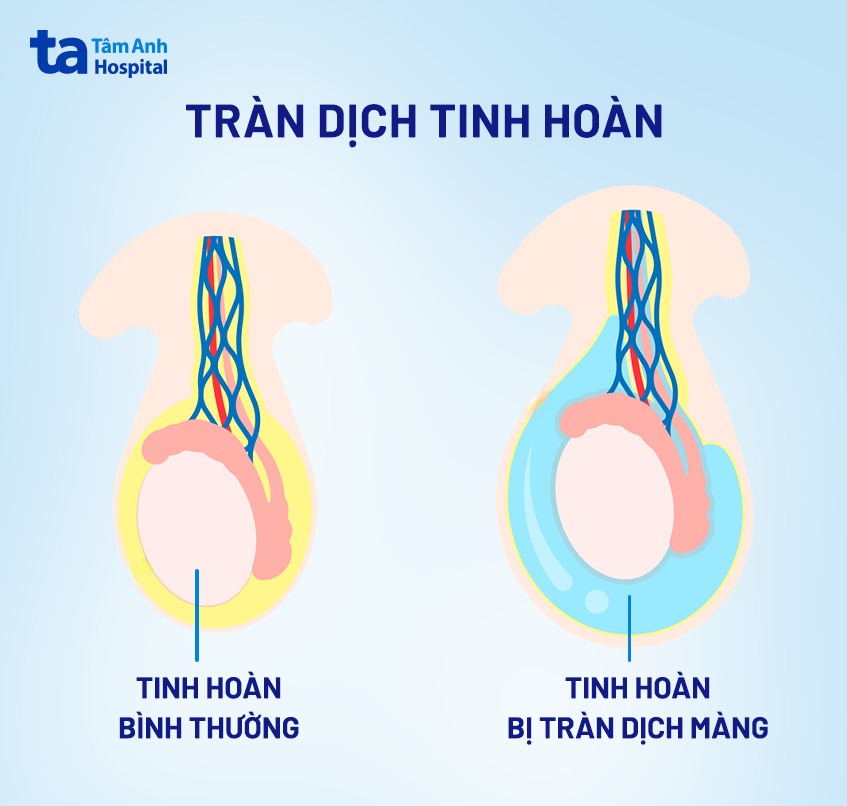 Tràn dịch màng tinh hoàn là một nguyên nhân khiến trẻ bị sa tinh hoàn