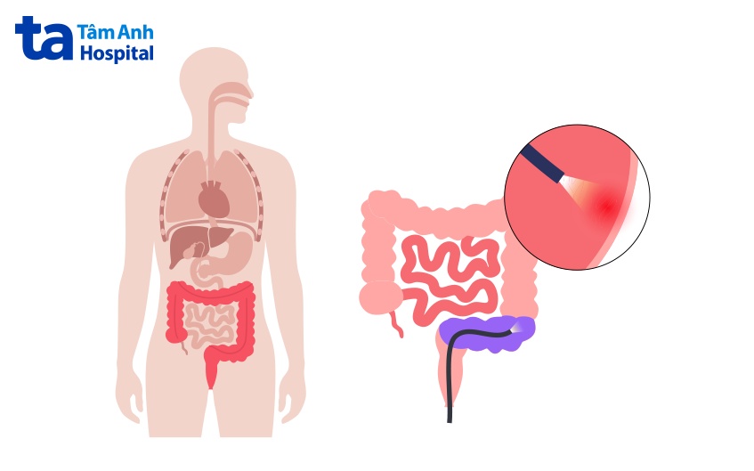 nội soi đường ruột chẩn đoán bệnh gì