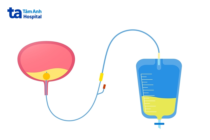 Ống thông tiểu dùng để dẫn lưu bàng quang