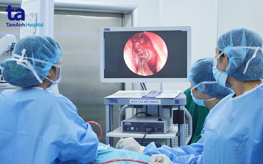 phẫu thuật viêm xoang sàng
