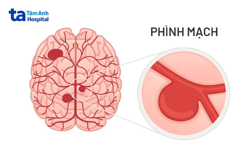 phình mạch não gây đau đầu ho