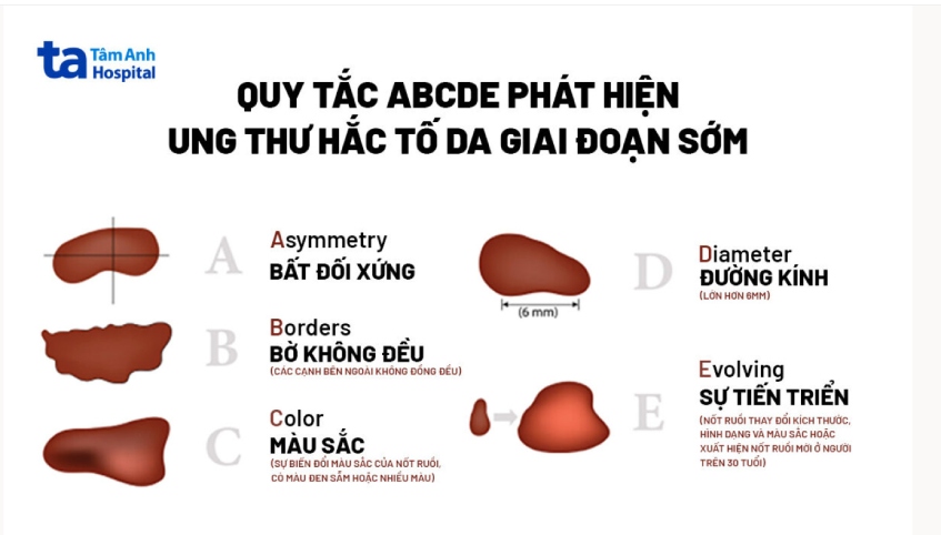 quy tắc abcde phát hiện ung thư hắc tố da