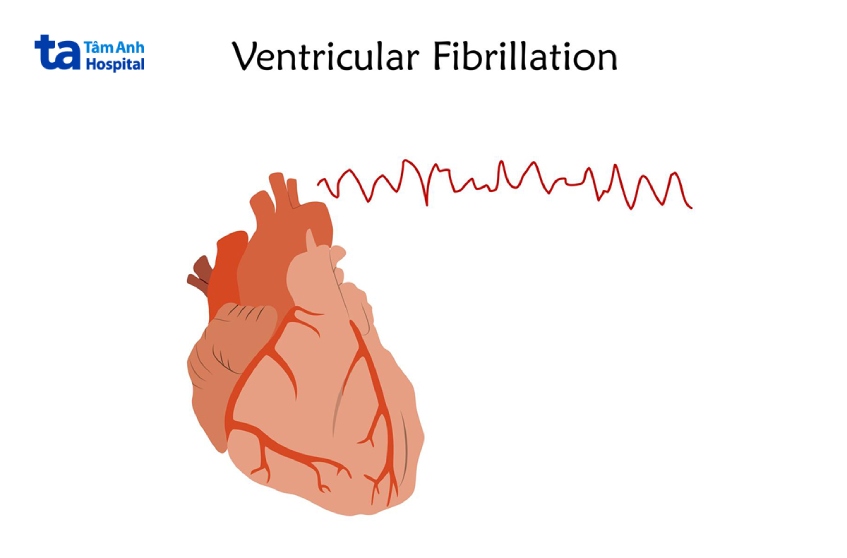 Rung tâm thất (VF) được biểu hiện bằng các gợn sớm nhỏ siêu nhanh, không đồng đều về thời gian và hình thái trên điện tâm đồ (ECG)