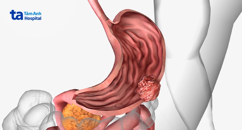 sinh thiết dạ dày để làm gì