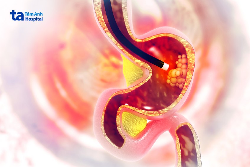 sinh thiết dạ dày là gì