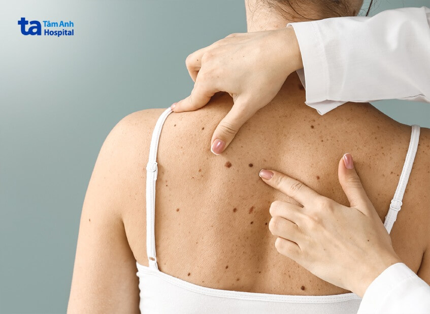 tầm soát bệnh ung thư da