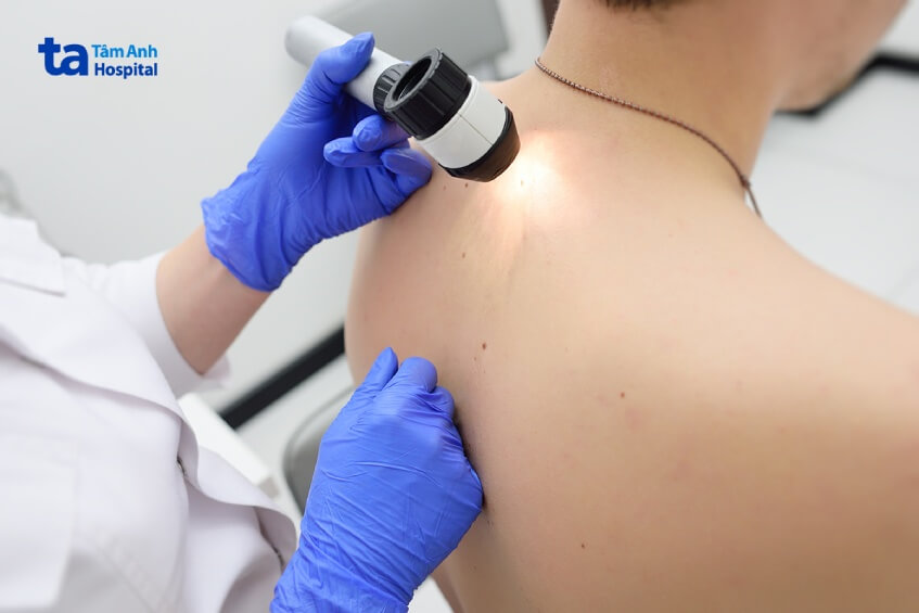 tầm soát phòng chống ung thư da