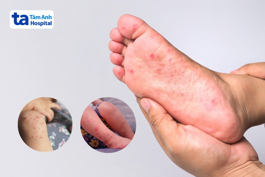 tay chân miệng với phát ban xuất hiện ở chân, gối