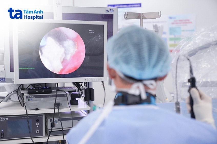 Thao tác tán sỏi được thực hiện thuận lợi với sự hỗ trợ của hệ thống
