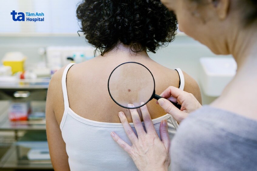 theo dõi tầm soát dấu hiệu ung thư da