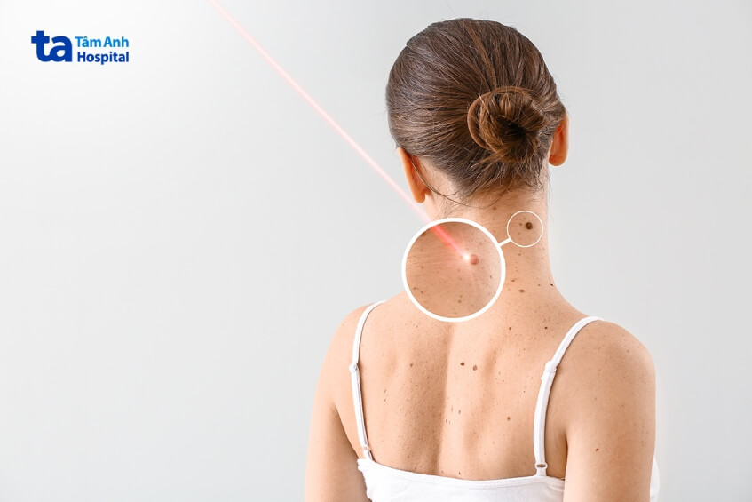 tiên lượng ung thư da sống được bao lâu