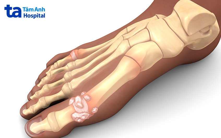 tinh thể acid uric tích tụ trong khớp