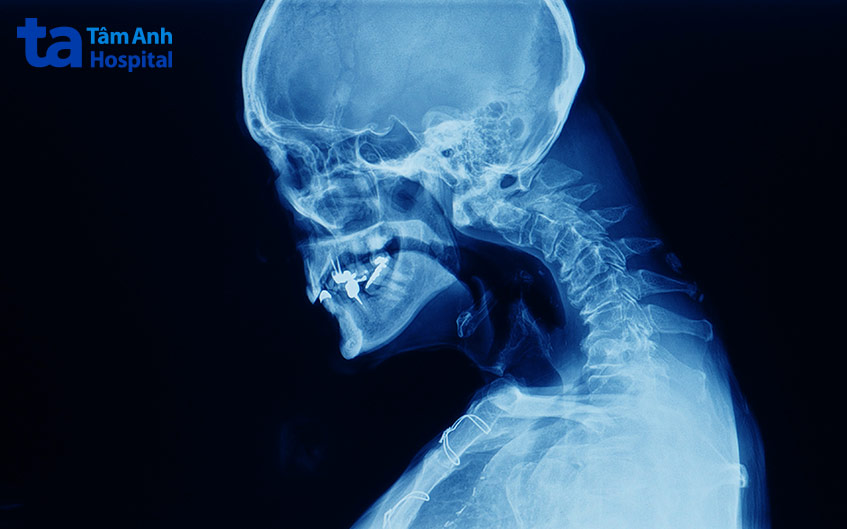 tình trạng gù lưng