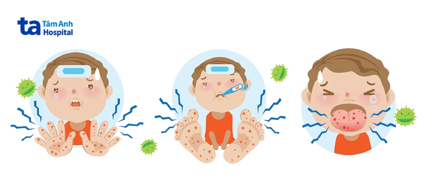 Trẻ xuất hiện các nốt ban ở tay, chân, miệng