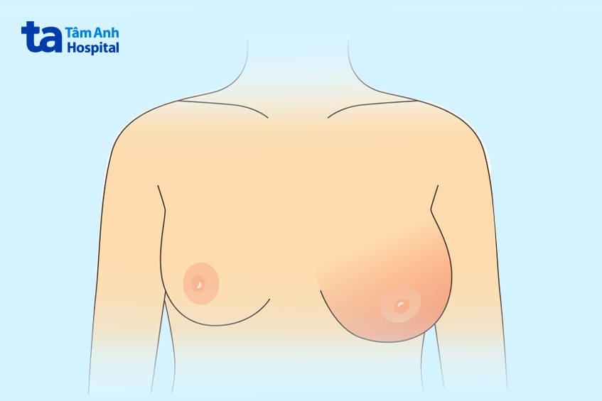 Triệu chứng nhiễm trùng túi ngực