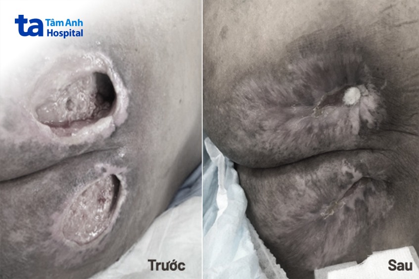 Vết loét lành hẳn sau ba tháng điều trị dinh dưỡng
