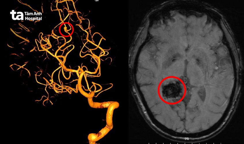 vị trí vỡ mạch máu não
