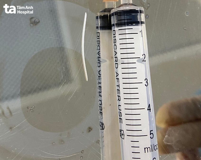 xương cá được gắp ra