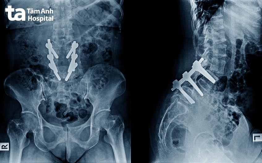 xương được cấy ghép