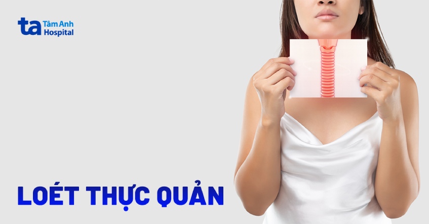 bệnh loét thực quản