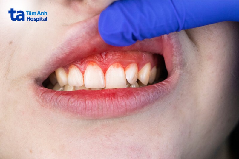 Bệnh nướu răng là gì?