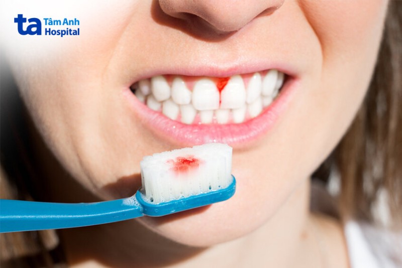 Triệu chứng của các bệnh về nướu răng