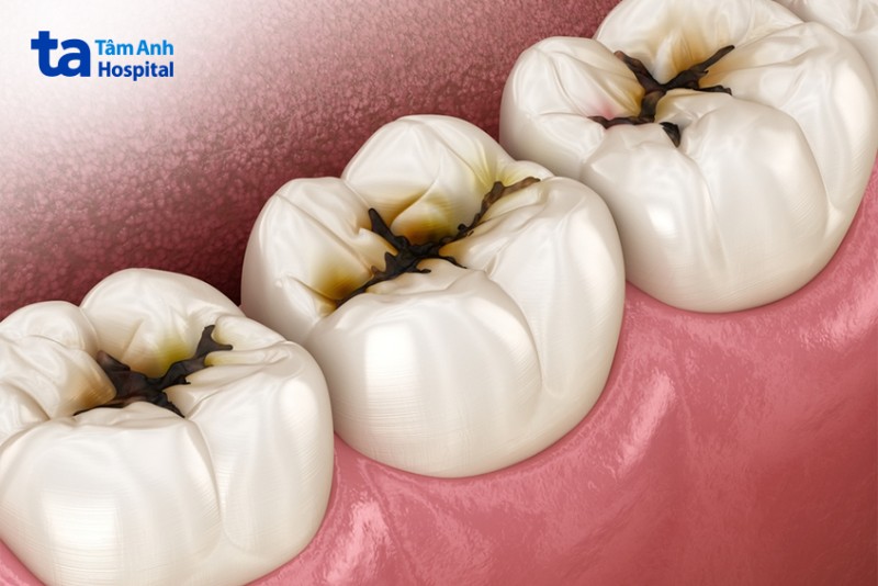Các yếu tố nguy cơ gây sâu răng