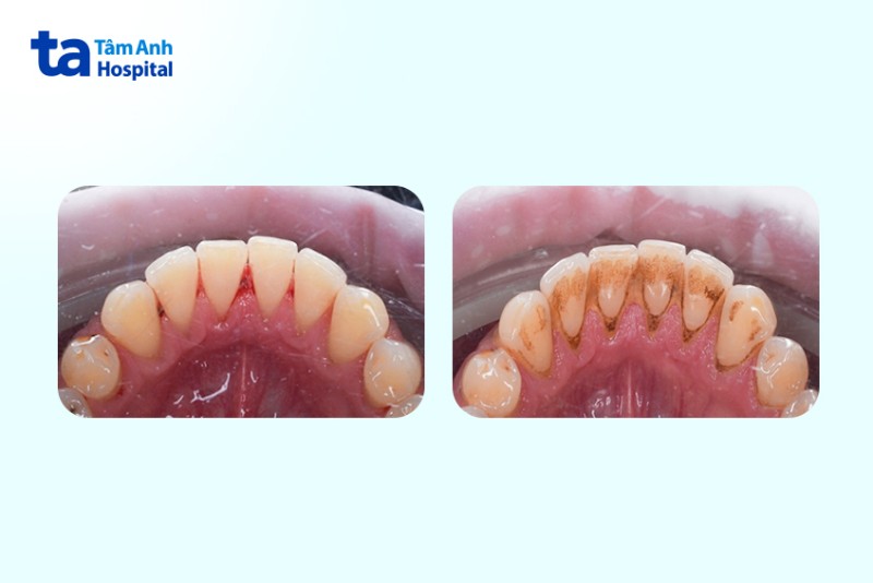 Phân độ cao răng