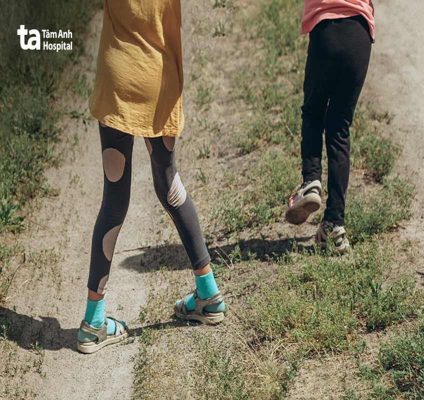 Biến chứng chân chữ bát (X) do bệnh còi xương ở trẻ