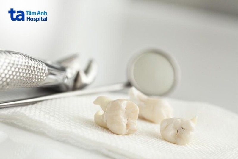 Biến chứng gì nếu không nhổ răng?