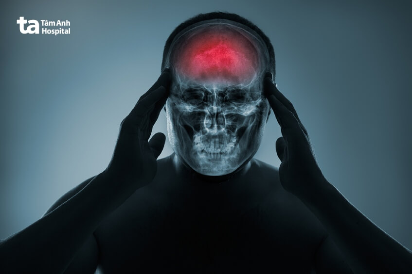 biến chứng sau mổ ghép sọ