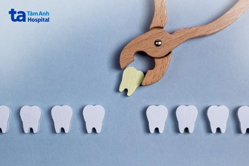 Các biến chứng sau nhổ răng có thể gặp phải