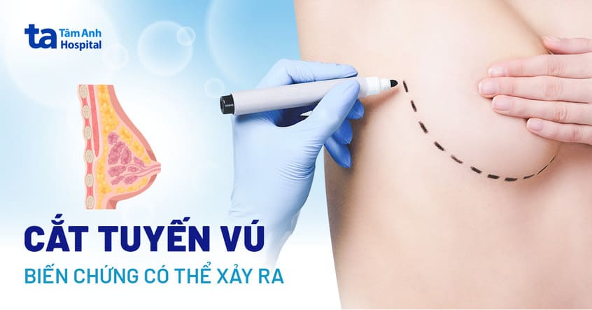 10 biến chứng sau phẫu thuật đoạn nhũ (cắt bỏ vú) có thể xảy ra