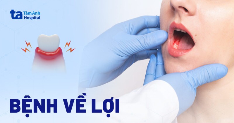 2 bệnh về lợi (nướu): Nguyên nhân, dấu hiệu và cách phòng ngừa