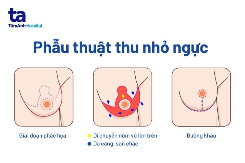 Các bước phẫu thuật thu nhỏ ngực.