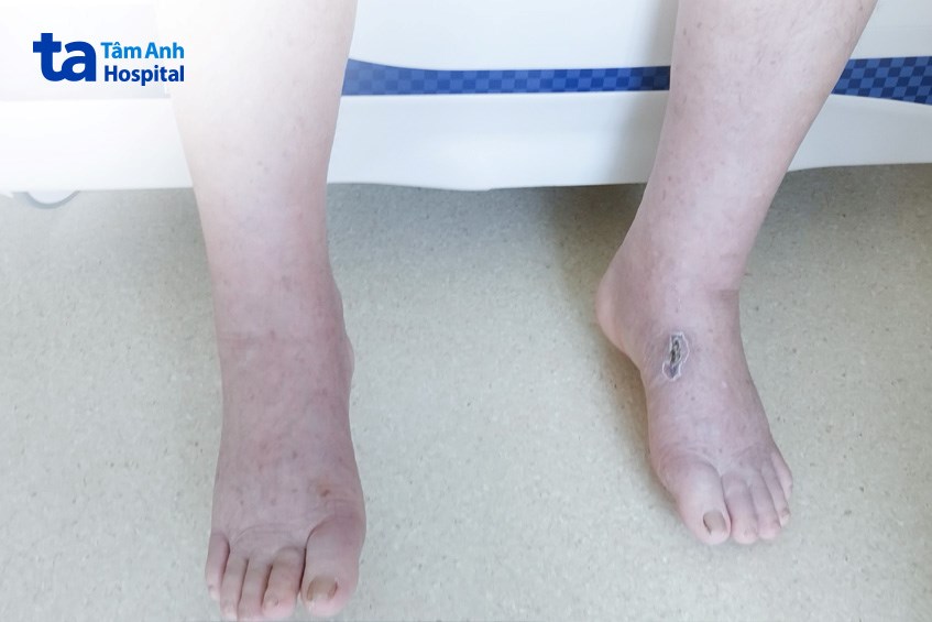 chân bớt phù sau khi điều trị 