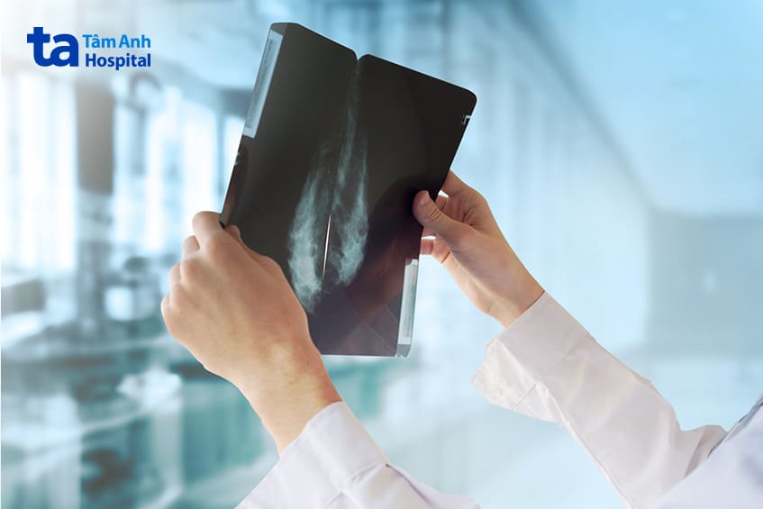 chẩn đoán bị ung thư vú dạng nhú