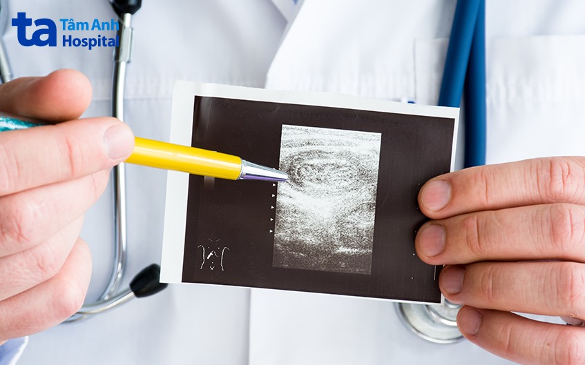 Chẩn đoán lồng ruột qua hình ảnh