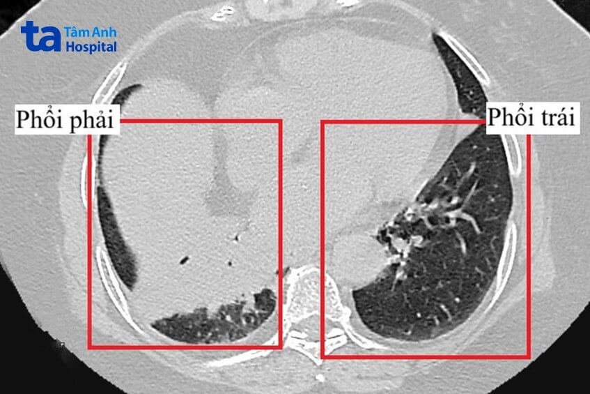 chẩn đoán mảnh hạt điều nằm sâu trong phổi