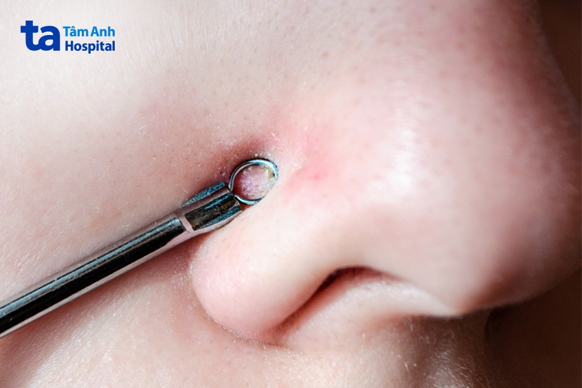 Chỉ sử dụng lực nhẹ để nặn mụn cám