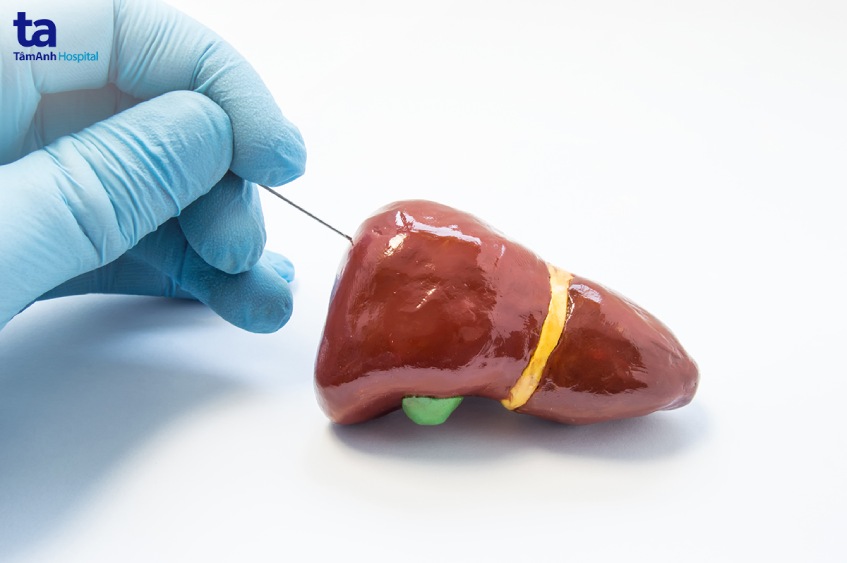 chọc sinh thiết gan